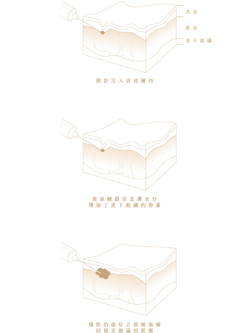 玻尿酸全臉雕塑